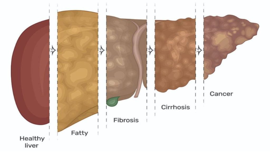 خطرات فیبرو اسکن کبد بررسی عوارض فیبرو اسکن کبد