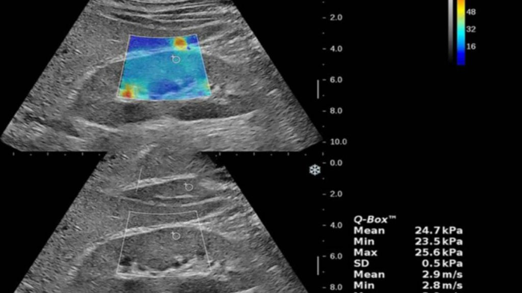 چگونگی خواندن جواب اسکن خواندن جواب فیبرو اسکن کبد