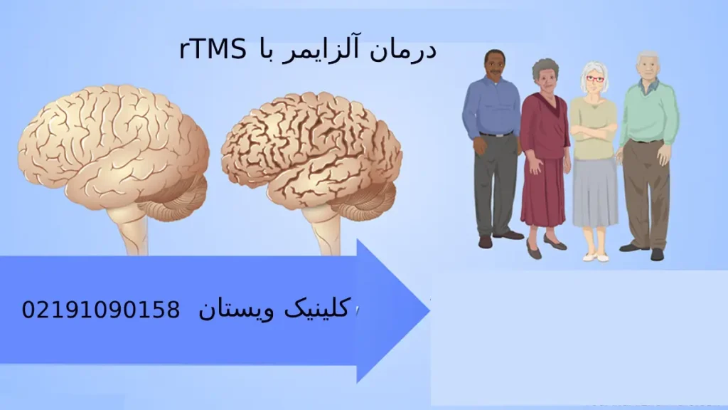 درمان آلزایمر با rTMS