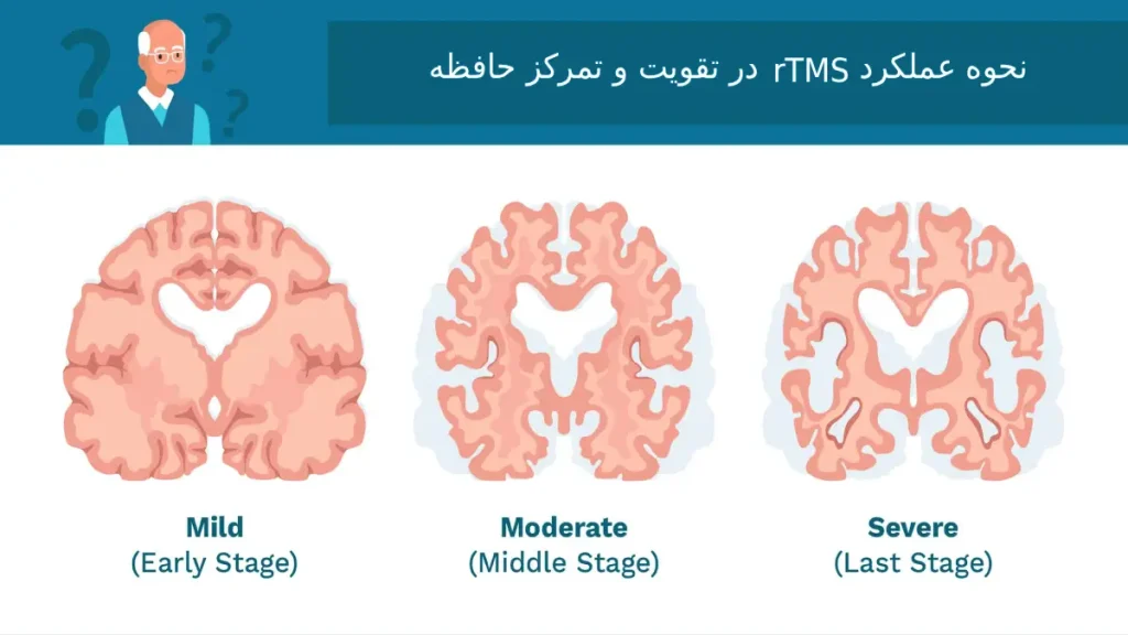 نحوه عملکرد rTMS در تقویت حافظه و تمرکز نحوه عملکرد rTMS در تقویت حافظه و تمرکز