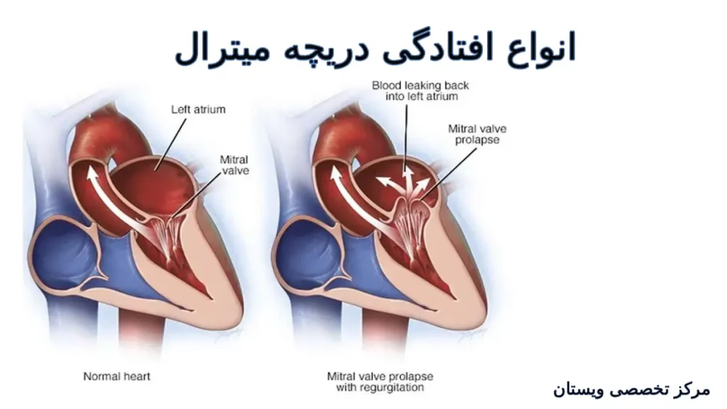 انواع افتادگی دریچه میترال انواع افتادگی دریچه میترال