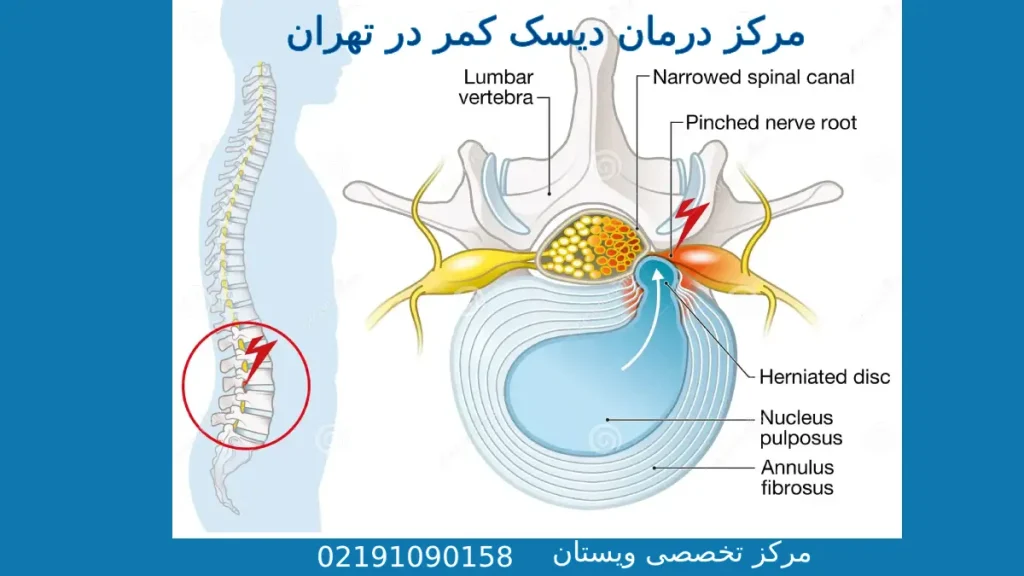 مرکز درمان دیسک کمر در تهران