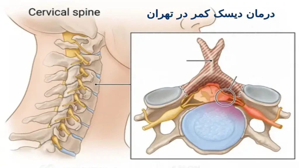 درمان دیسک کمر در تهران