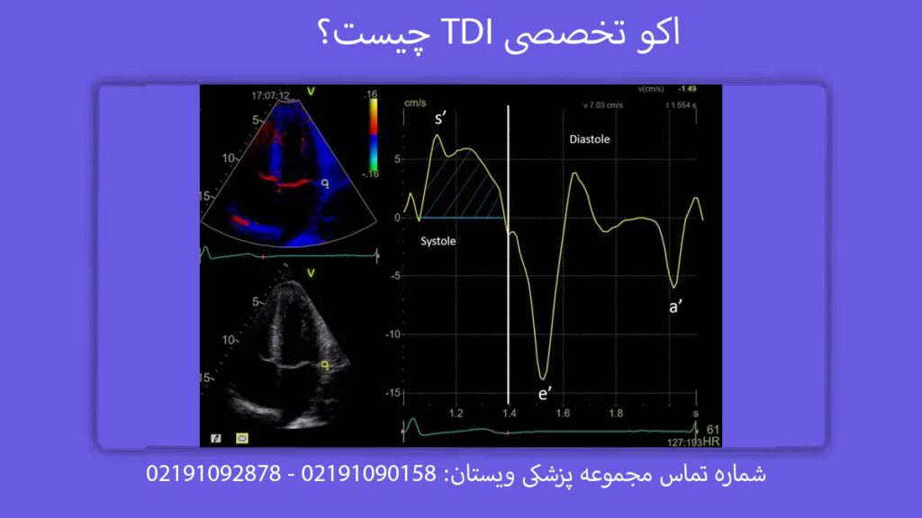 اکو تخصصی TDI چیست؟