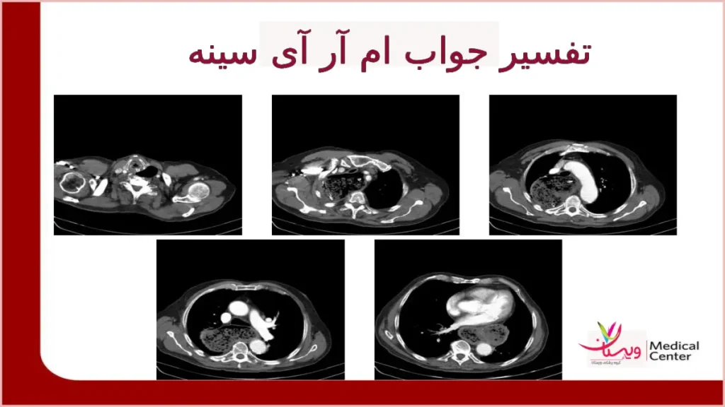 تفسیر جواب ام آر آی سینه