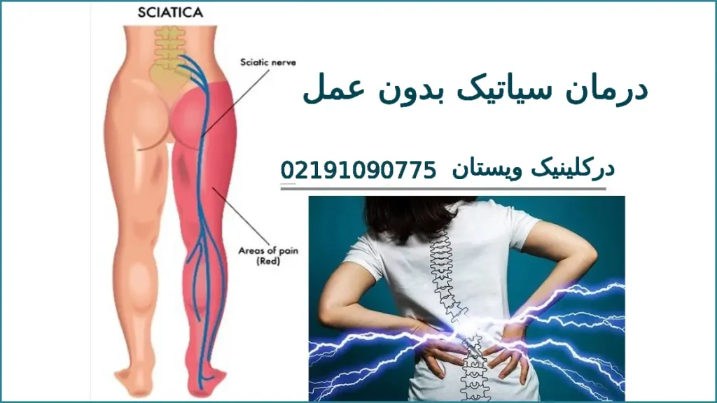 درمان سیاتیک بدون عمل