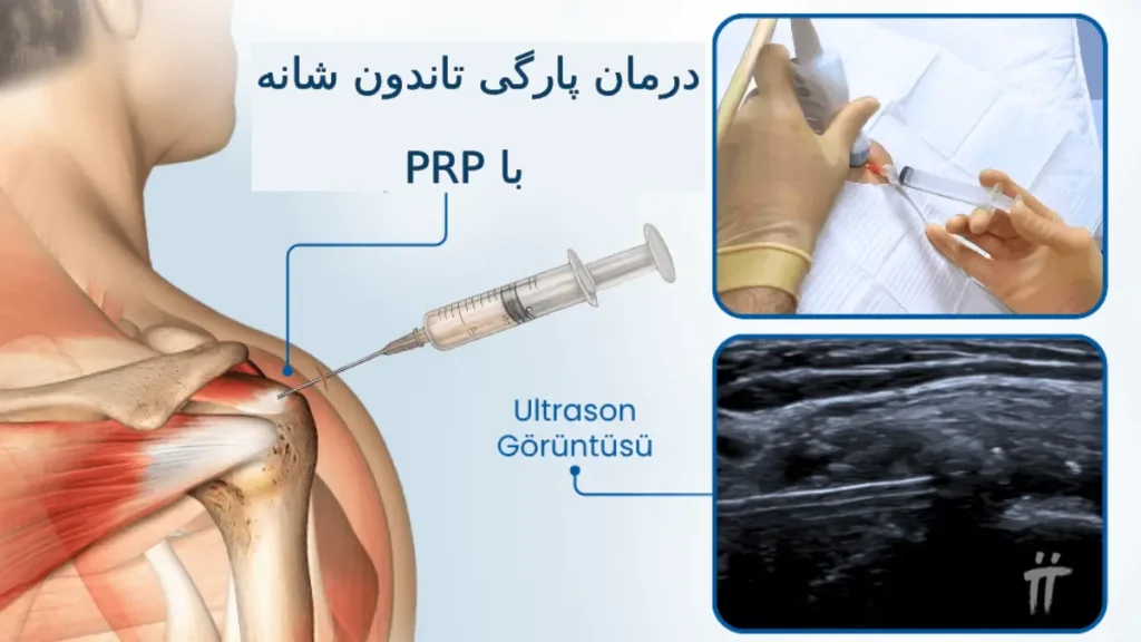 درمان پارگی تاندون شانه با PRP