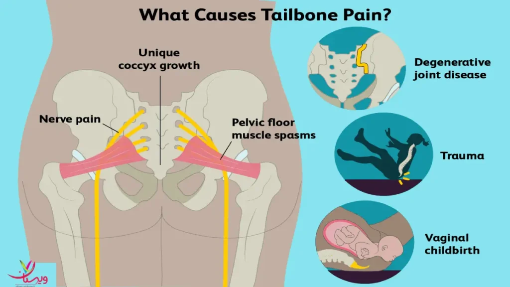 روشهای درمان درد دنبالچه مقایسه روشهای درمان درد دنبالچه