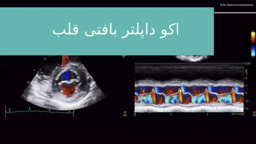 اکوکاردیوگرافی داپلر بافتی