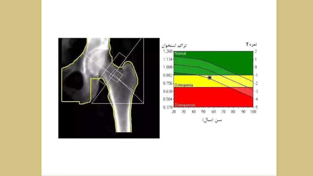 قیمت آزمایش تراکم استخوان هزینه آزمایش تراکم استخوان
